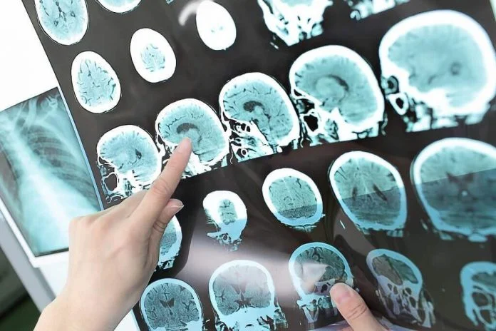 Tumor Otak: Penyebab, Gejala, Diagnosis dan Pengobatan